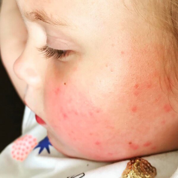 علائم سرخچه آلمانی